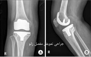 جراحی تعویض مفصل زانو