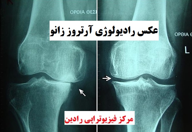 عکس ارتروز آرتروز زانو