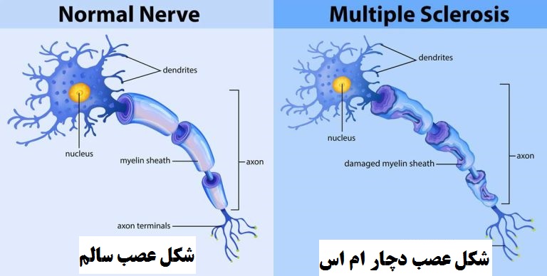 ام اس چیست علایم ام اس