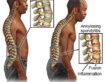 روماتیسم ستون فقرات چیست و چگونه درمان می شود؟